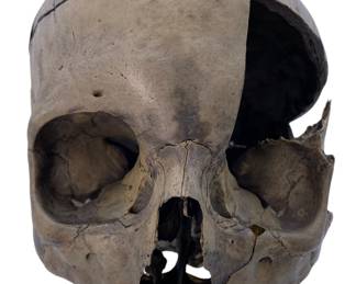 Early Human Skull: Approximately 20” circumference, saw cut in the past into 3 parts - temporarily held in place with museum putty