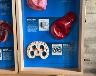 Wooden display case by Health Edco/WRS, containing educational models on the consequences of drug abuse. Case includes realistic anatomical representations of organ damage, such as brain infection, heart infection, vein damage, and birth defects. Accompanied by a ‘Substance Abuse Identification Guide’ and foam padding for storage. Case is equipped with clasps and a black handle. Exterior shows scratches and wear. Measures (closed), 27.75” H x 14” W.
